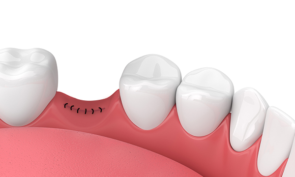 Наложение швов во рту