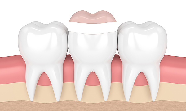 Удаление пломбы