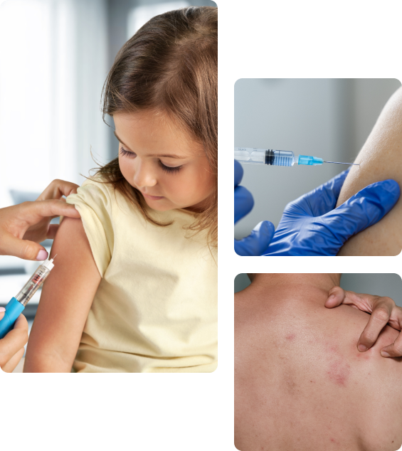 Осложнения после прививки от ветрянки Осложнения после прививки от ветрянки