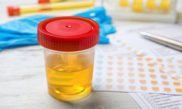 Общий анализ мочи