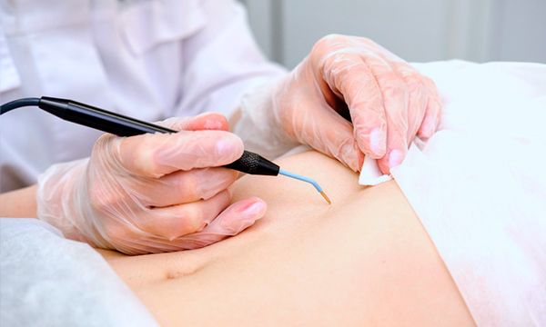 Электрокоагуляция