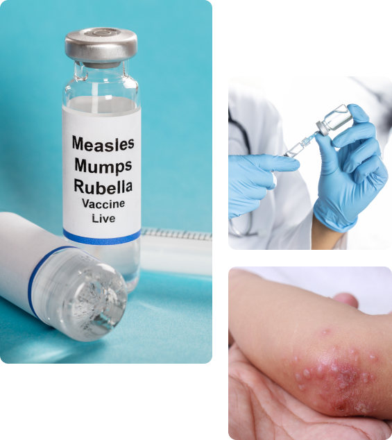 Осложнения после вакцинации от краснухи