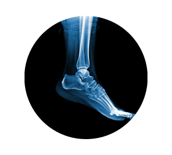 Рентген пяточной кости