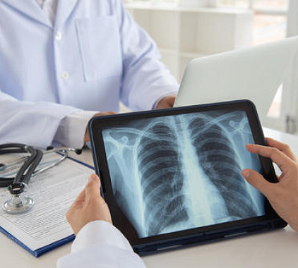 Рентген ребер