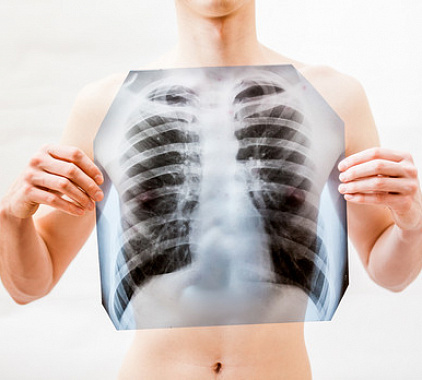 Рентген легких