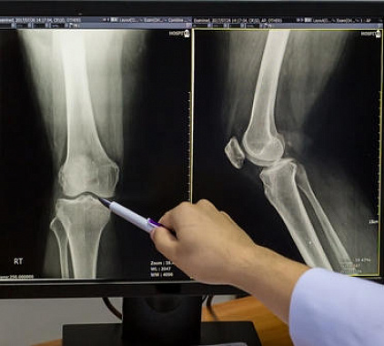 Рентген костей