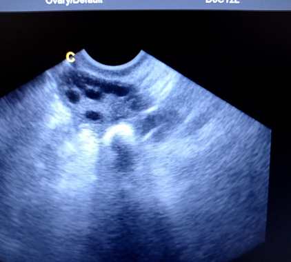 УЗИ яичников УЗИ яичников