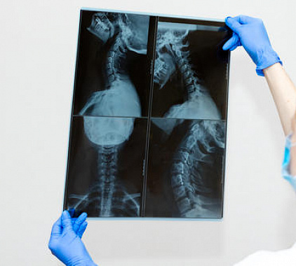 Рентген шейного отдела позвоночника