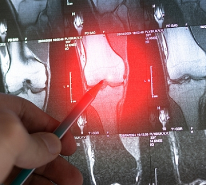 Рентген коленного сустава