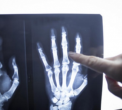 Рентген пальцев