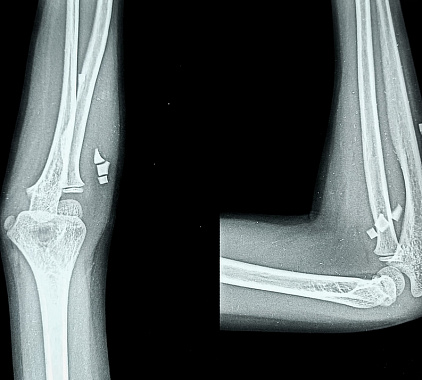 Рентген локтевого сустава