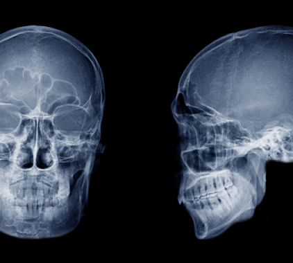 Рентген пазух носа