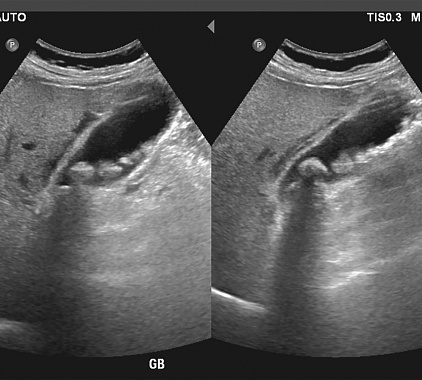 УЗИ мочевого пузыря