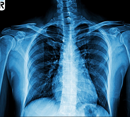 Рентген лопатки